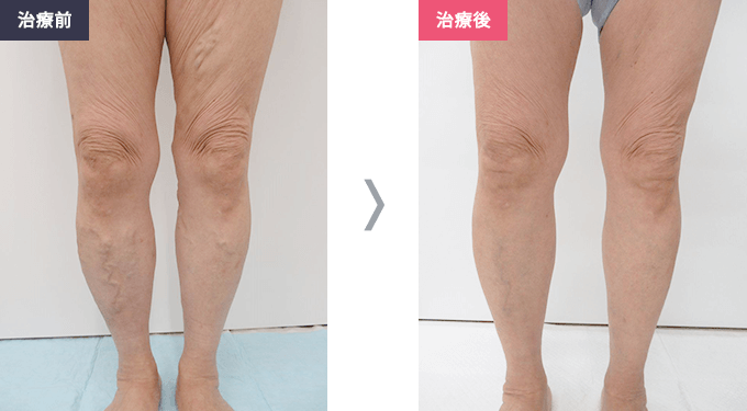 70代女性の治療例