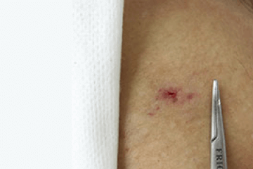 スタブ・アバルジョン法