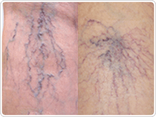 網目状／クモの巣状