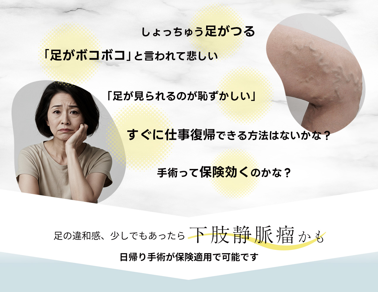 下肢静脈瘤の種類