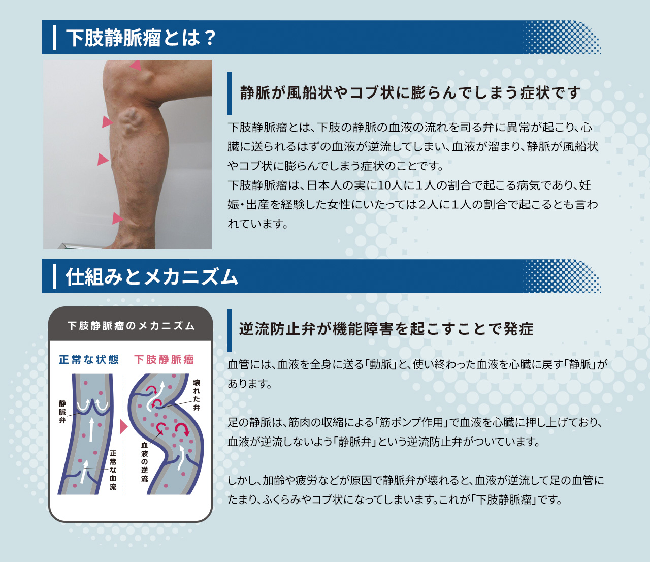 下肢静脈瘤とは