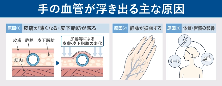 手や手の甲の血管が浮き出る主な原因をまとめたイメージ図