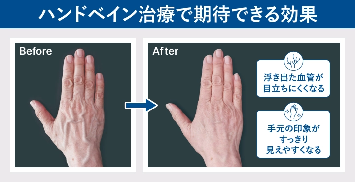 ハンドベイン治療による変化（血管が目立ちにくくなり、手元がすっきり見えやすくなる）のイメージ図