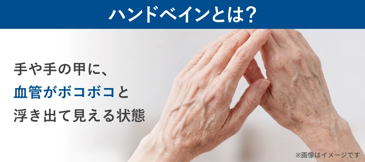 ハンドベインの特徴（手や手の甲に血管がボコボコと浮き出た状態）のイメージ図