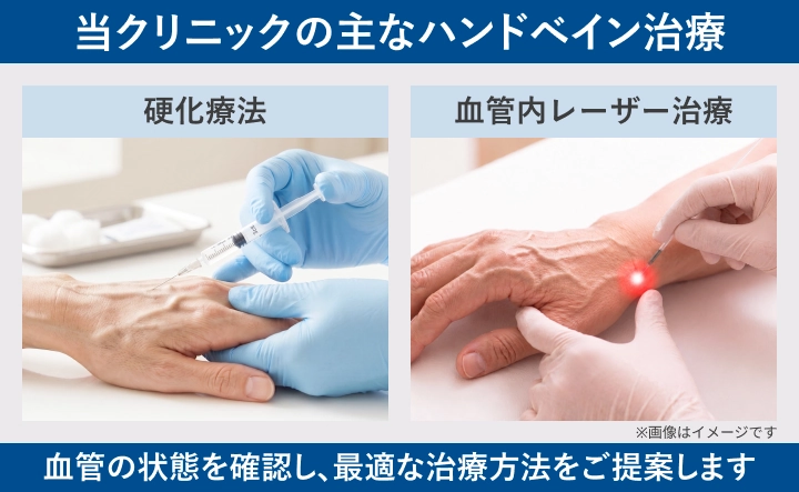 当クリニックで行うハンドベイン治療（硬化療法・血管内レーザー治療）のイメージ図